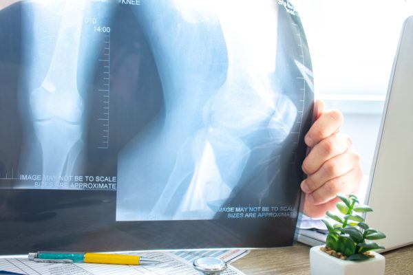 Que es tendinitis rotuliana prevencion 